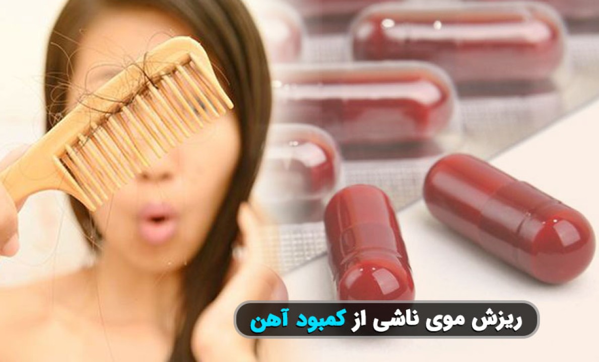 کمبود آهن و ریزش مو؛ چگونه بفهمیم ریزش مو ناشی از فقر آهن است؟